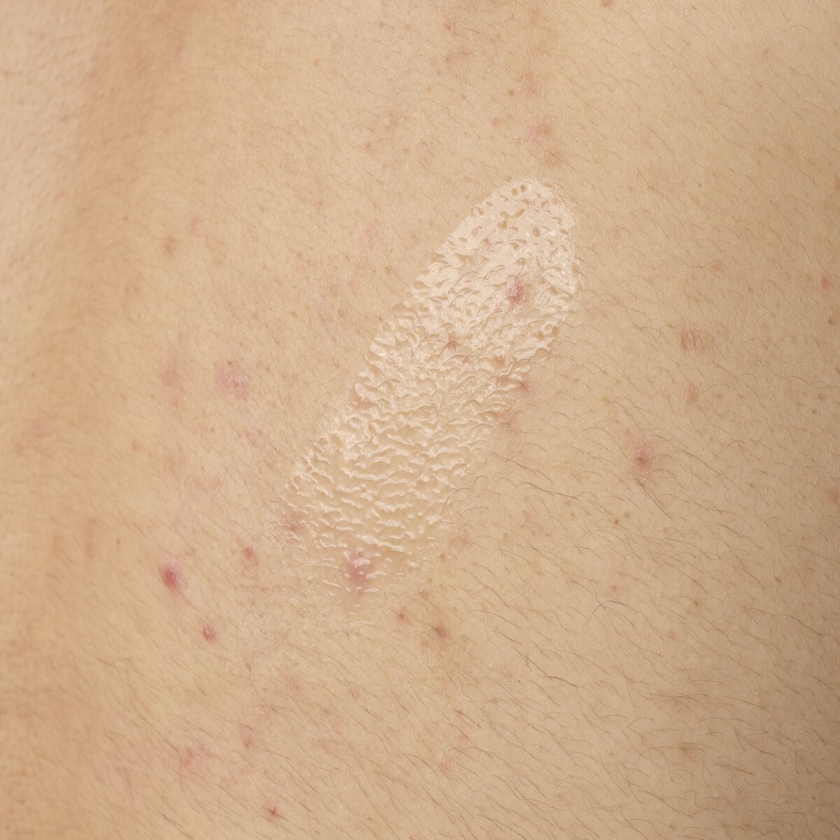 salicylic-acid-0-5-body-serum-u2 ORD-salicylic-acid-05-body-240ml-application.jpg