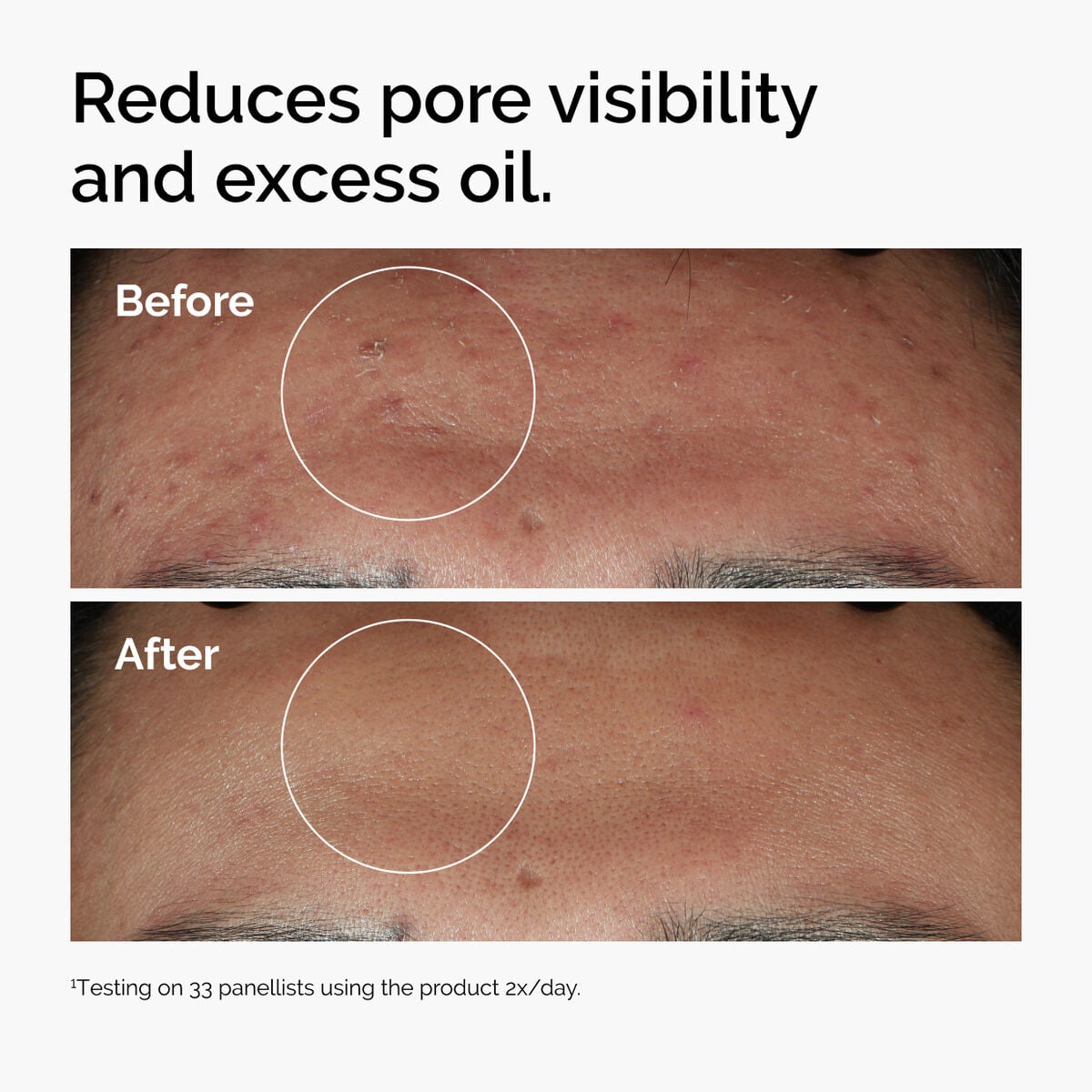 niacinamide-10-zinc-1-s1 ord-niacinamide-zinc-blemish-serum-before-after-pores.jpg