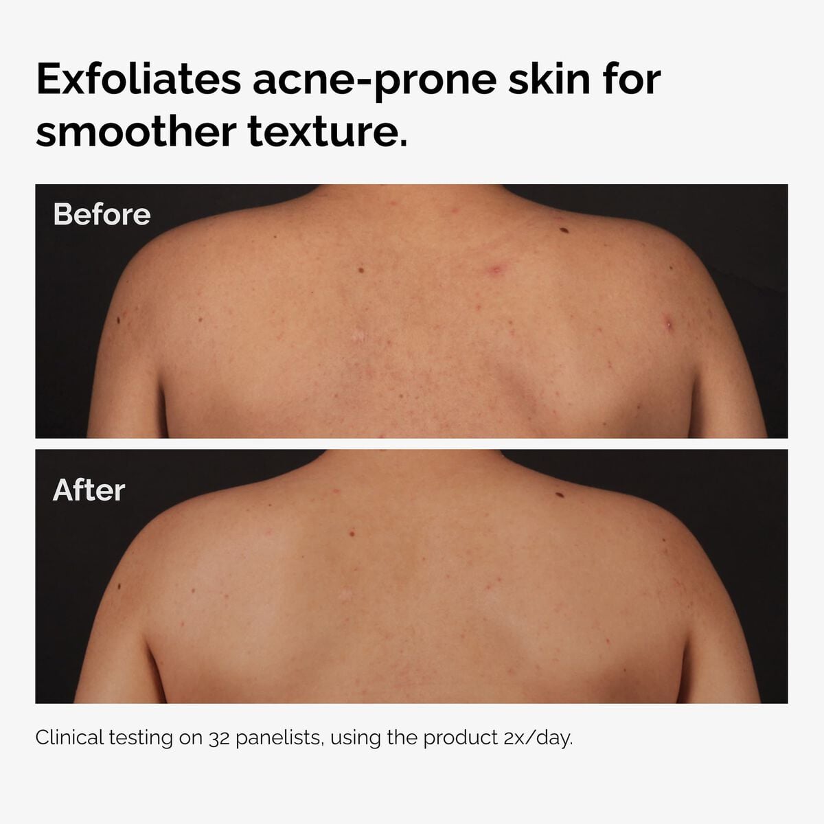 salicylic-acid-0-5-body-serum-u2 ord-salicylic-acid-body-serum-before-after-graphic-NA.jpg