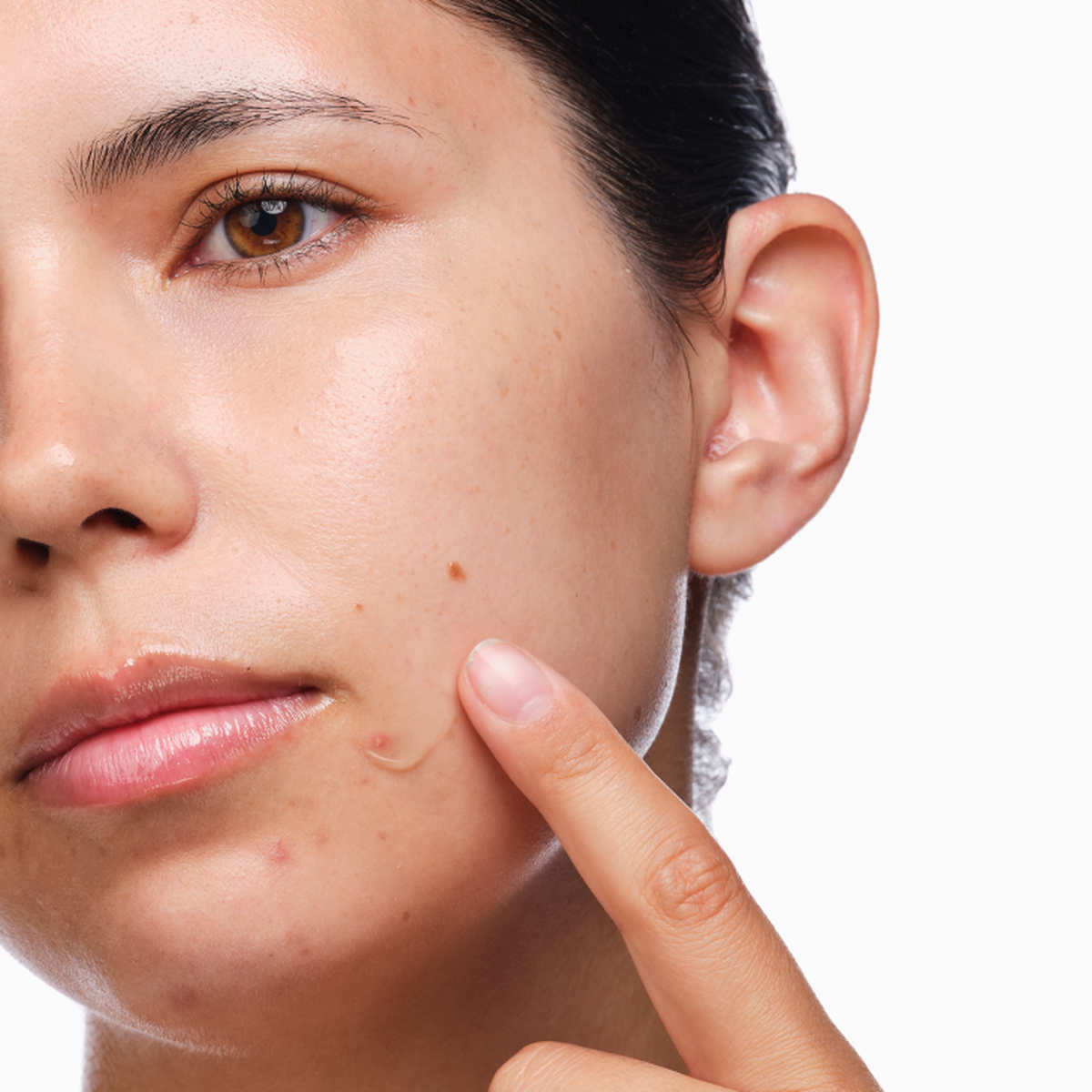 the-acne-set-m6 rdn-the-acne-set-application.png